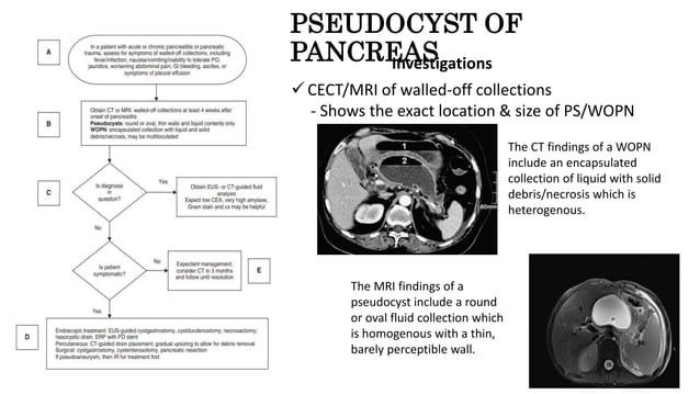 Pseudocyst Of Pancreas How To DIAGNOSE TREAT Epigastric Lumps pseudocyst-of-pancreas-how-to-diagnose-treat-epigastric-lumps