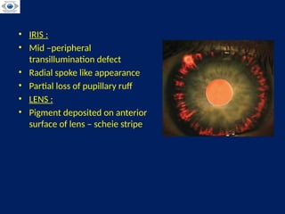 Comprehensive Overview of Pseudoexfoliation and Pigment Dispersion ...