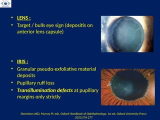 Comprehensive Overview of Pseudoexfoliation and Pigment Dispersion ...