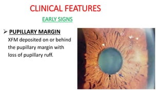 CLINICAL FEATURES
EARLY SIGNS
 PUPILLARY MARGIN
XFM deposited on or behind
the pupillary margin with
loss of pupillary ruff.
 
