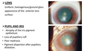 LENS
Uniform ,homogenous/ground glass
appearance of the anterior lens
surface.
PUPIL AND IRIS
• Atrophy of the iris pigment
epithelium
• Loss of pupillary ruff
• Poor mydriasis
• Pigment dispertion after pupillary
dilatation.
 
