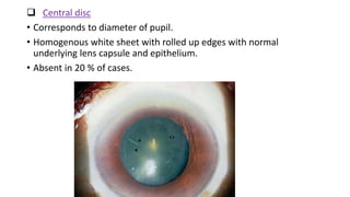  Central disc
• Corresponds to diameter of pupil.
• Homogenous white sheet with rolled up edges with normal
underlying lens capsule and epithelium.
• Absent in 20 % of cases.
 