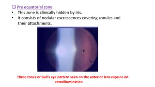  Pre equatorial zone
• This zone is clinically hidden by iris.
• It consists of nodular excrescences covering zonules and
their attachments.
Three zones or Bull’s eye pattern seen on the anterior lens capsule on
retroillumination
 