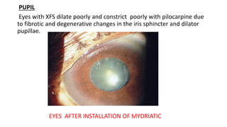 PUPIL
Eyes with XFS dilate poorly and constrict poorly with pilocarpine due
to fibrotic and degenerative changes in the iris sphincter and dilator
pupillae.
EYES AFTER INSTALLATION OF MYDRIATIC
 