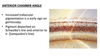 ANTERIOR CHAMBER ANGLE
• Increased trabecular
pigmentation is a early sign on
gonioscopy.
• Pigment deposited on
Schwalbe’s line and anterior to
it (Sampaolesi’s line).
 