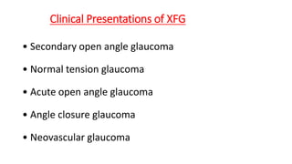 Clinical Presentations of XFG
• Secondary open angle glaucoma
• Normal tension glaucoma
• Acute open angle glaucoma
• Angle closure glaucoma
• Neovascular glaucoma
 