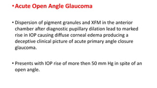 •Acute Open Angle Glaucoma
• Dispersion of pigment granules and XFM in the anterior
chamber after diagnostic pupillary dilation lead to marked
rise in IOP causing diffuse corneal edema producing a
deceptive clinical picture of acute primary angle closure
glaucoma.
• Presents with IOP rise of more then 50 mm Hg in spite of an
open angle.
 