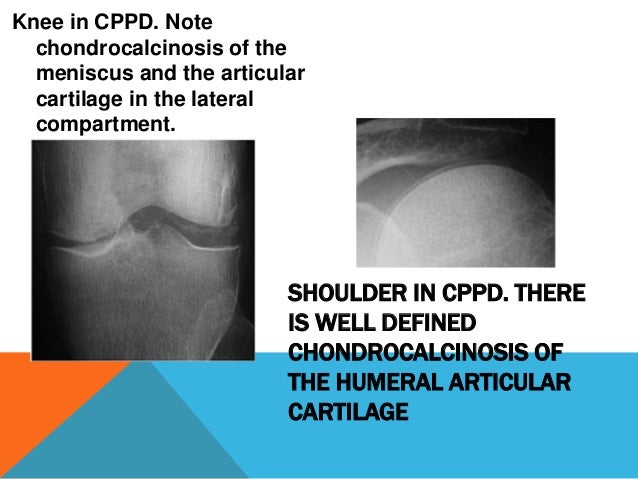 pseudogout light and gout