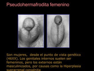 Pseudohermafrodita femenino
Son mujeres, desde el punto de vista genético
(46XX). Los genitales internos suelen ser
femeninos, pero los externos están
masculinizados, por causas como la Hiperplasia
suprarrenal congénita
 