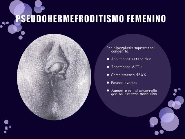 Featured image of post View 16 Pseudo Hermafroditismo Humano