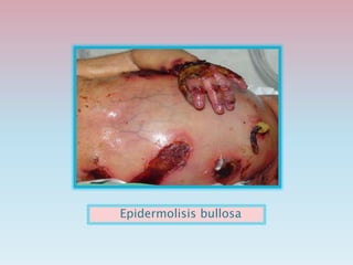 Epidermolisis bullosa
 