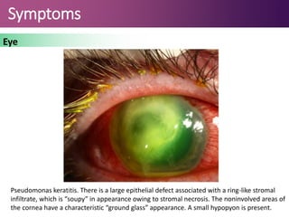 Symptoms
Eye
Pseudomonas keratitis. There is a large epithelial defect associated with a ring-like stromal
infiltrate, which is “soupy” in appearance owing to stromal necrosis. The noninvolved areas of
the cornea have a characteristic “ground glass” appearance. A small hypopyon is present.
 