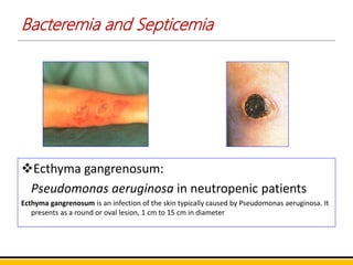 Pseudomonas aeruginosa | PPTX