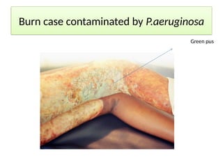 Burn case contaminated by P.aeruginosa
Green pus
 