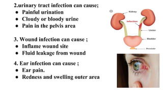 2.urinary tract infection can cause;
● Painful urination
● Cloudy or bloody urine
● Pain in the pelvis area
3. Wound infection can cause ;
● Inflame wound site
● Fluid leakage from wound
4. Ear infection can cause ;
● Ear pain.
● Redness and swelling outer area
 