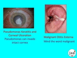 Pseudomonas Keratitis and
Corneal Ulceration
Pseudomonas can invade
intact cornea
Malignant Otitis Externa
Mind the word malignant
 