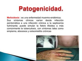 Melioidosis : es una enfermedad muermo-endémica;
Sus síntomas clínicos varían desde infección
asintomática a una infección crónica a la septicemia
fulminante; puede simular la fiebre tifoidea o más
comúnmente la tuberculosis, con síntomas tales como
empiema, abscesos y osteomielitis crónicas
 