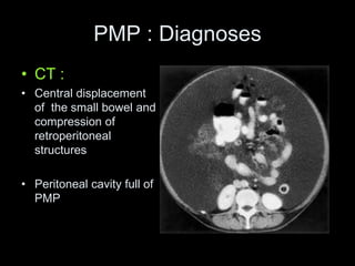 PMP : Diagnoses
• CT :
• Central displacement
of the small bowel and
compression of
retroperitoneal
structures
• Peritoneal cavity full of
PMP
 