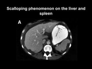 Scalloping phenomenon on the liver and
spleen
 