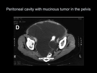 Peritoneal cavity with mucinous tumor in the pelvis
 