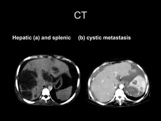 CT
Hepatic (a) and splenic (b) cystic metastasis
 