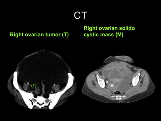 CT
Right ovarian tumor (T)
Right ovarian solido
cystic mass (M)
(T) M
 