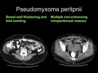 Pseudomyxoma peritpnii
Bowel wall thickening and
fold swelling
Multiple non-enhancing
intraperitoneal masses
 