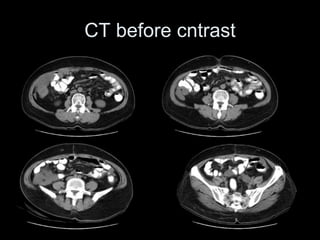 CT before cntrast
 