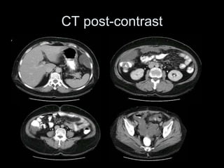 CT post-contrast
 