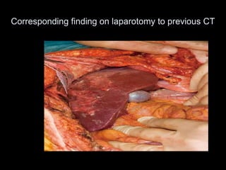 Corresponding finding on laparotomy to previous CT
 