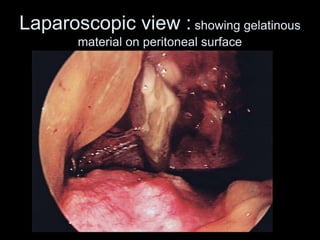 Laparoscopic view : showing gelatinous
material on peritoneal surface
 