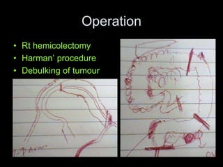 Operation
• Rt hemicolectomy
• Harman’ procedure
• Debulking of tumour
 