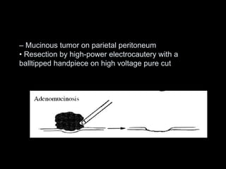 – Mucinous tumor on parietal peritoneum
• Resection by high-power electrocautery with a
balltipped handpiece on high voltage pure cut
 