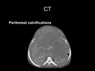 CT
Peritoneal calcifications
 