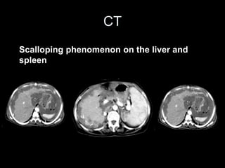 CT
Scalloping phenomenon on the liver and
spleen
 