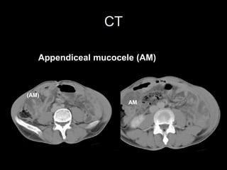 CT
Appendiceal mucocele (AM)
(AM)
AM
 