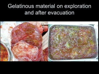 Gelatinous material on exploration
and after evacuation
 