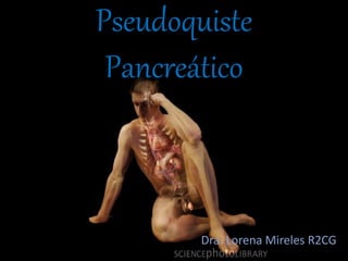 Pseudoquiste
Pancreático
Dra. Lorena Mireles R2CG
 