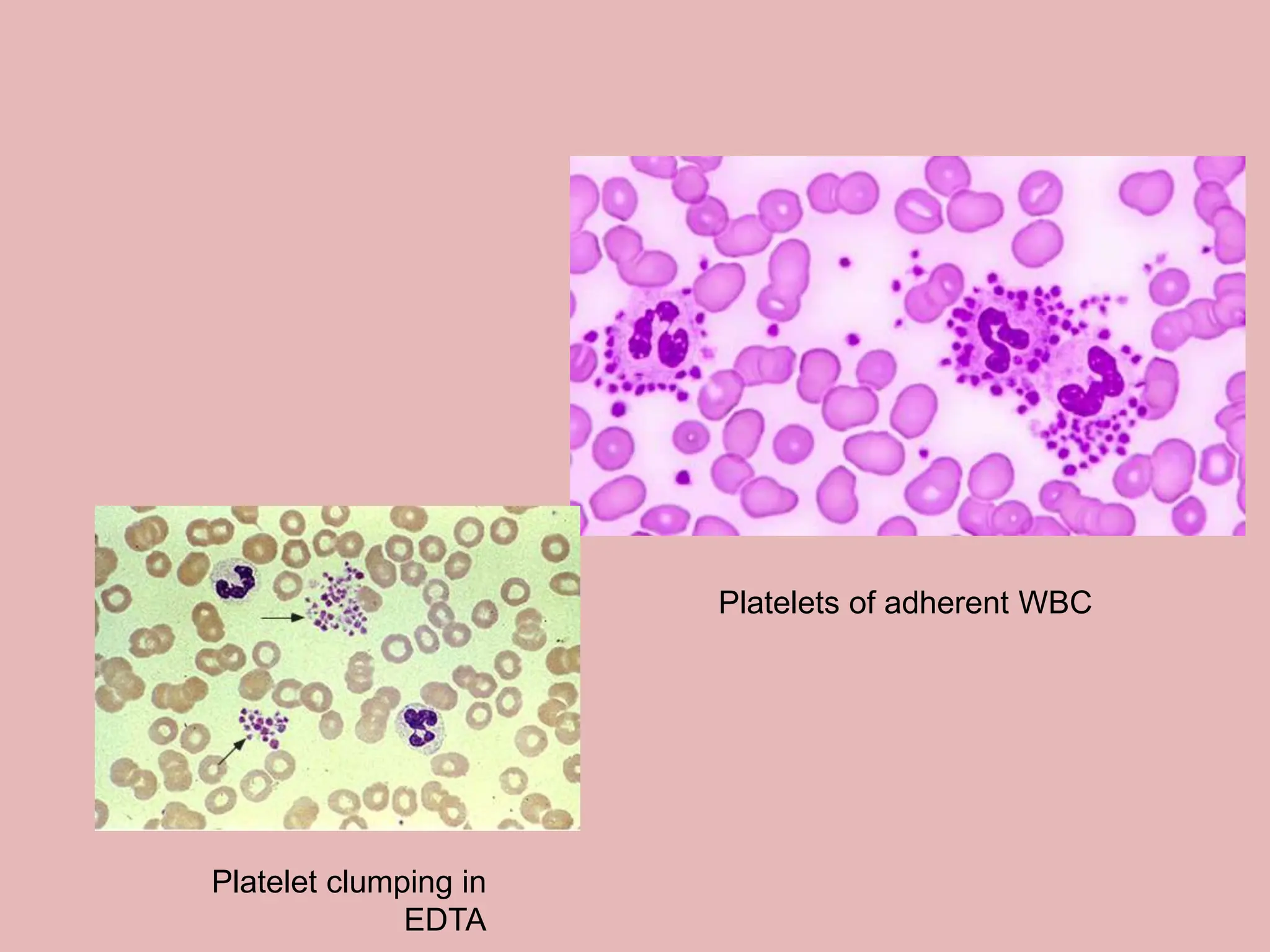 Pseudothrombocytopenia pptx pseudothrombocytopenia-pptx