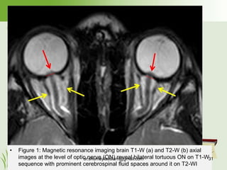 Pseudotumor cerebri, Idiopathic Intracranial Hypertension | PPTX