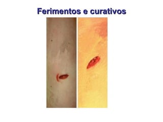 Ferimentos e curativos 