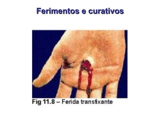 Ferimentos e curativos 