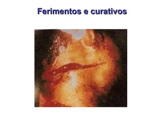 Ferimentos e curativos 