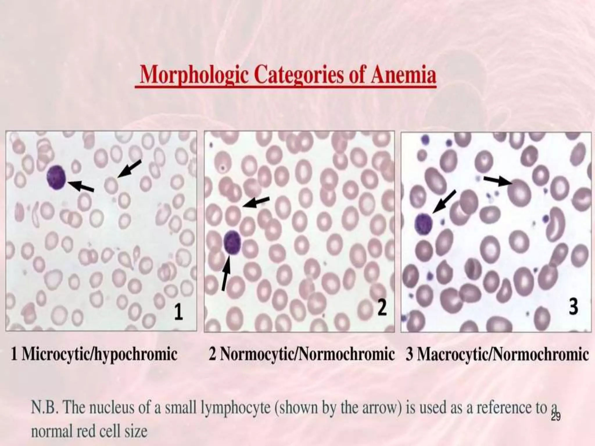 PS Findings In Hemolytic Anemia.pptx