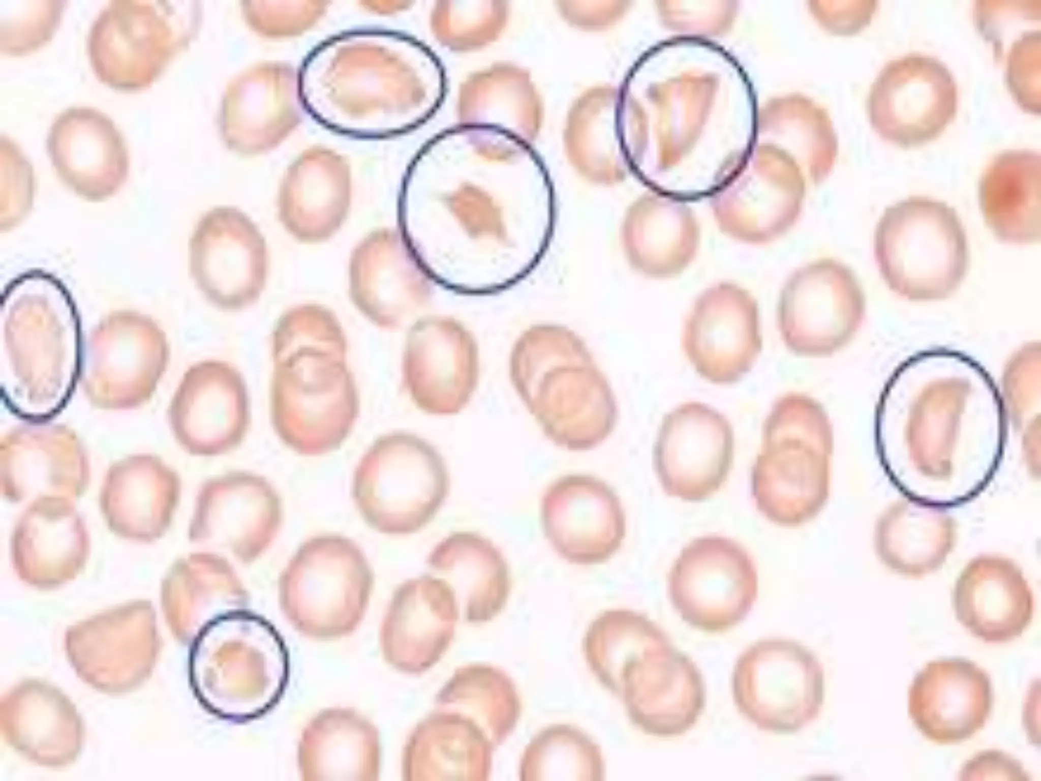 PS Findings In Hemolytic Anemia.pptx