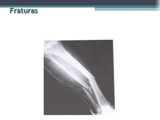 Fraturas 