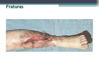 Fraturas 