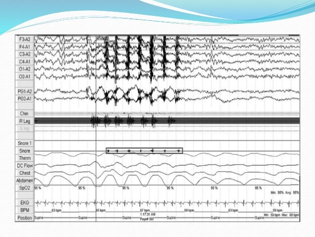polysomnography tech jobs polysomnography tech jobs