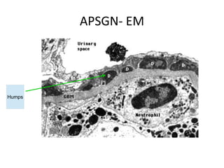 Psgn nephrotic syndrome | PPTX