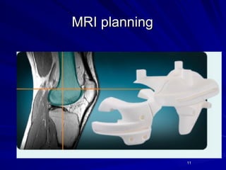 Mri Knee Ordering Guide.pdf Patient Specific Instrumentation in Total Knee Replacement | PPT